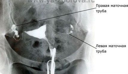 Узи на проходимость маточных труб как делают